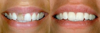 Smile Gallery - Pro Smiles Dental, Naperville Dentist