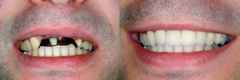 Smile Gallery - Pro Smiles Dental, Naperville Dentist