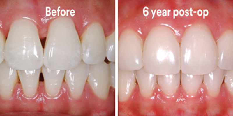 BioClear Diastema Closure and Black Triangle Closure  - Pro Smiles Dental, Naperville Dentist