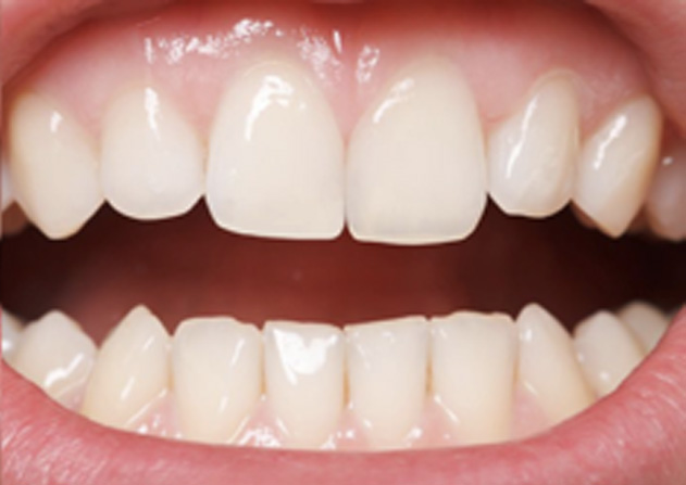 Cosmetic Bonding  - Pro Smiles Dental, Naperville Dentist