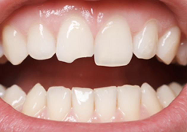 Cosmetic Bonding  - Pro Smiles Dental, Naperville Dentist