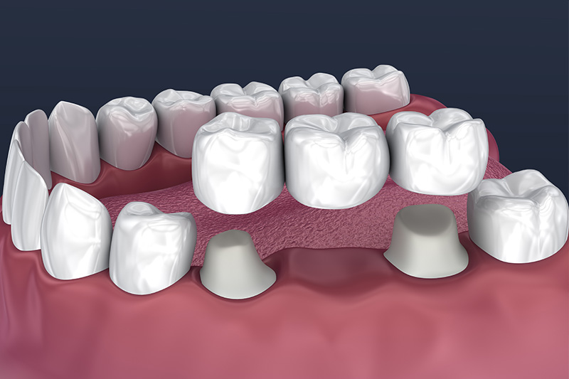 Crowns and Bridges, Inlays and Onlays  - Pro Smiles Dental, Naperville Dentist