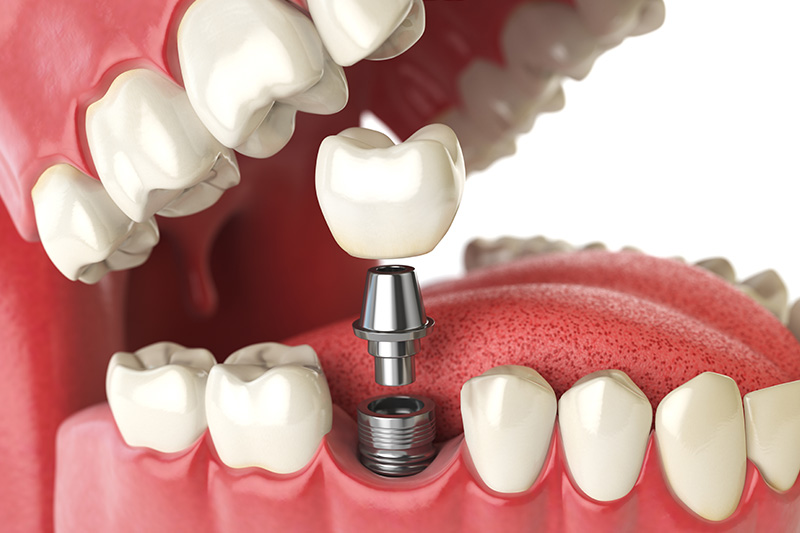 Dental Implants - Pro Smiles Dental, Naperville Dentist