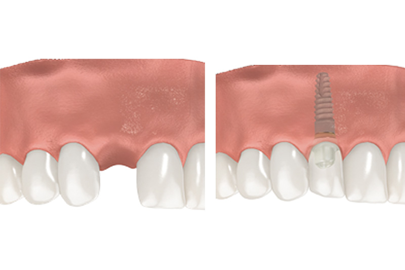 Dental Implants - Pro Smiles Dental, Naperville Dentist