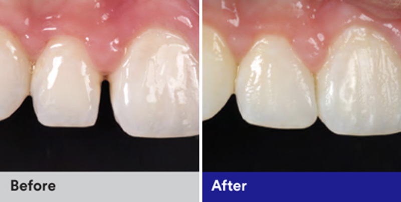 CLOSING THE GAP- DIASTEMA SPACE CLOSURE BETWEEN UPPER FRONT TEETH: OPTIONS  AND TREATMENT TECHNIQUES FOR NATURAL APPEARANCE - ETHAN HARRIS, DMD - Rock  'N' Roll Dental