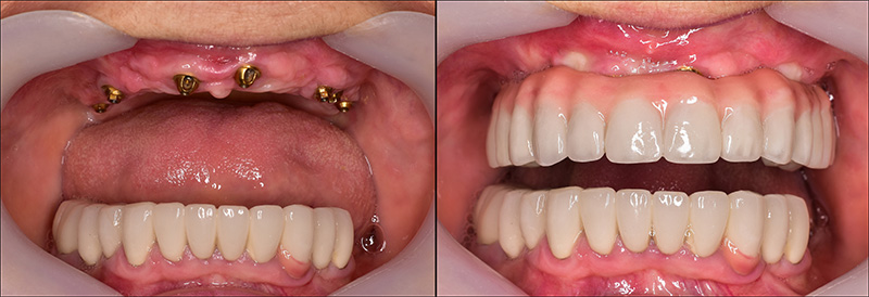 Implant Overdentures and Fixed All-On-X Treatment  - Pro Smiles Dental, Naperville Dentist