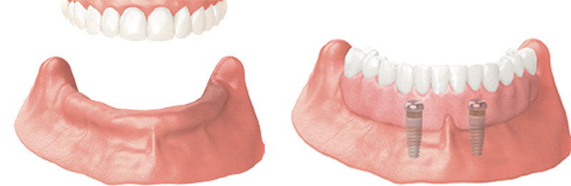 Implant Overdentures and Fixed All-On-X Treatment  - Pro Smiles Dental, Naperville Dentist