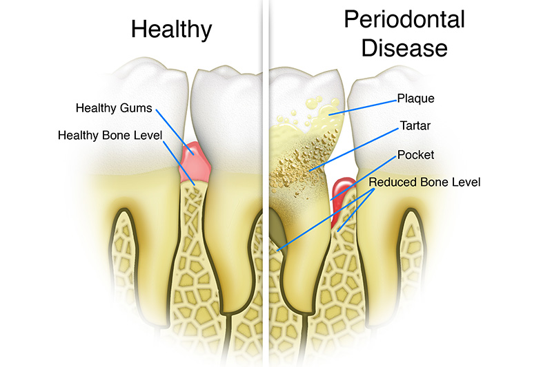 Scaling & Root Planings (Deep Cleanings)  - Pro Smiles Dental, Naperville Dentist