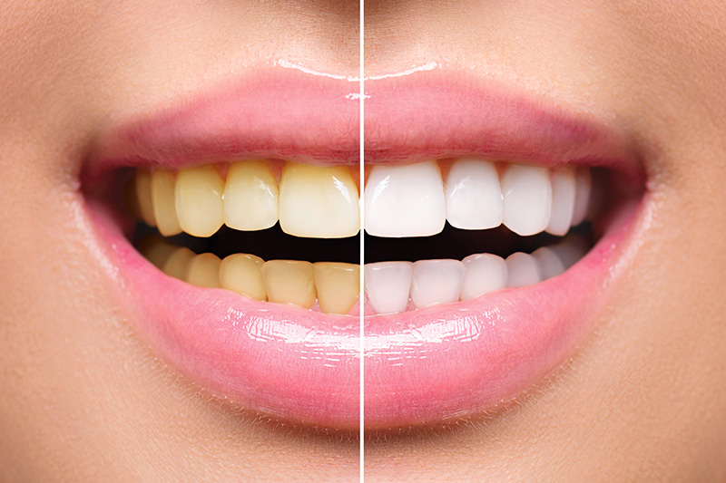 Teeth Whitening - Pro Smiles Dental, Naperville Dentist