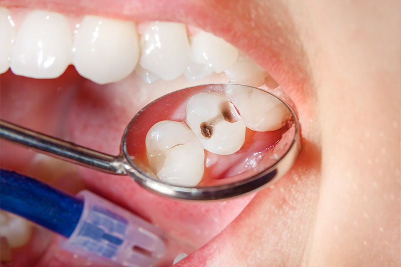 Tooth Colored Composite Fillings  - Pro Smiles Dental, Naperville Dentist