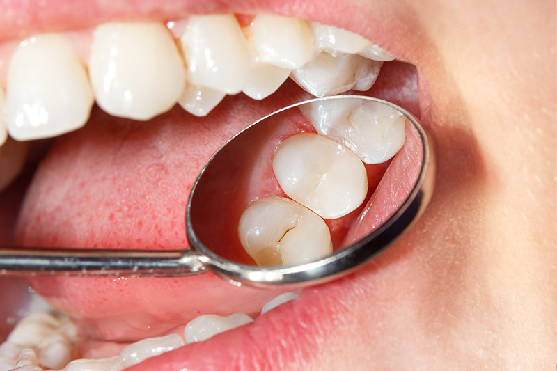 Tooth Colored Composite Fillings  - Pro Smiles Dental, Naperville Dentist