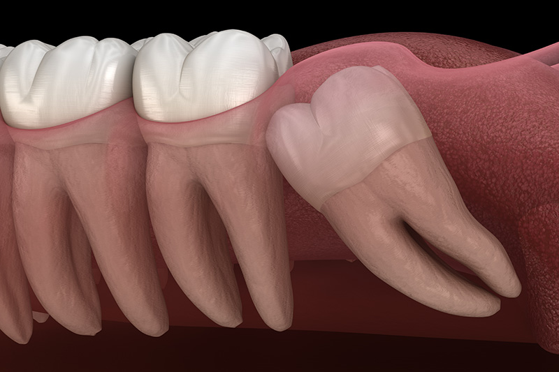 Wisdom Teeth Extractions (with Sedation)  - Pro Smiles Dental, Naperville Dentist